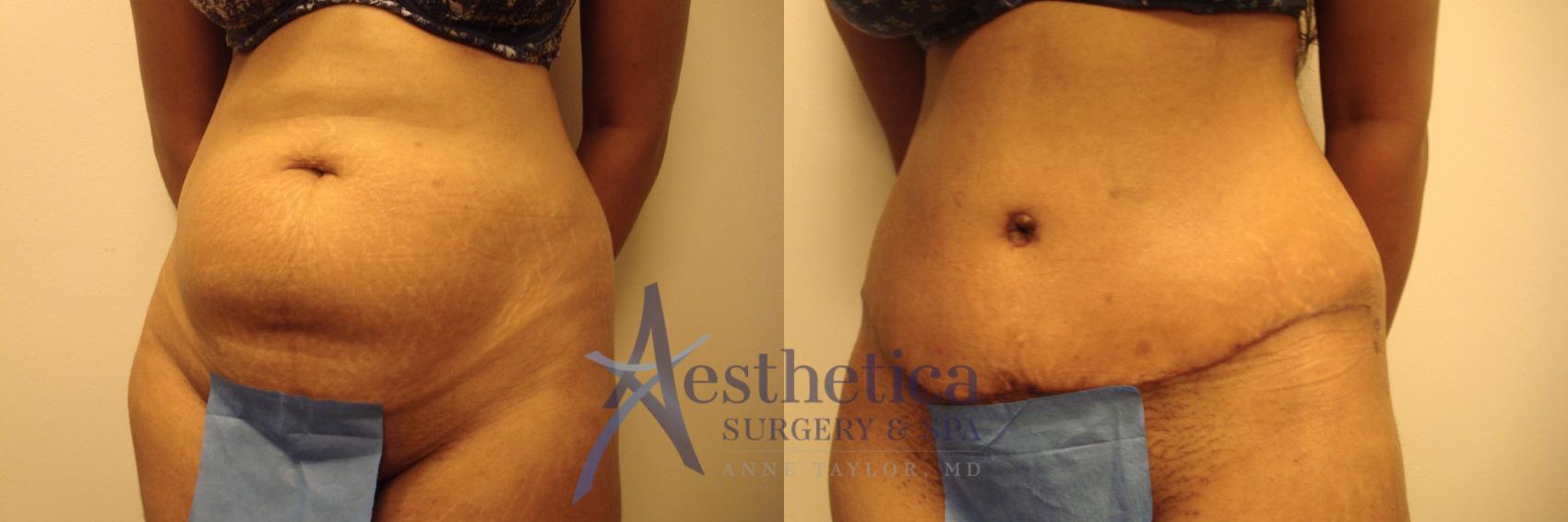 Tummy Tuck Case 443 Before & After Front | Worthington, OH | Aesthetica Surgery & Spa