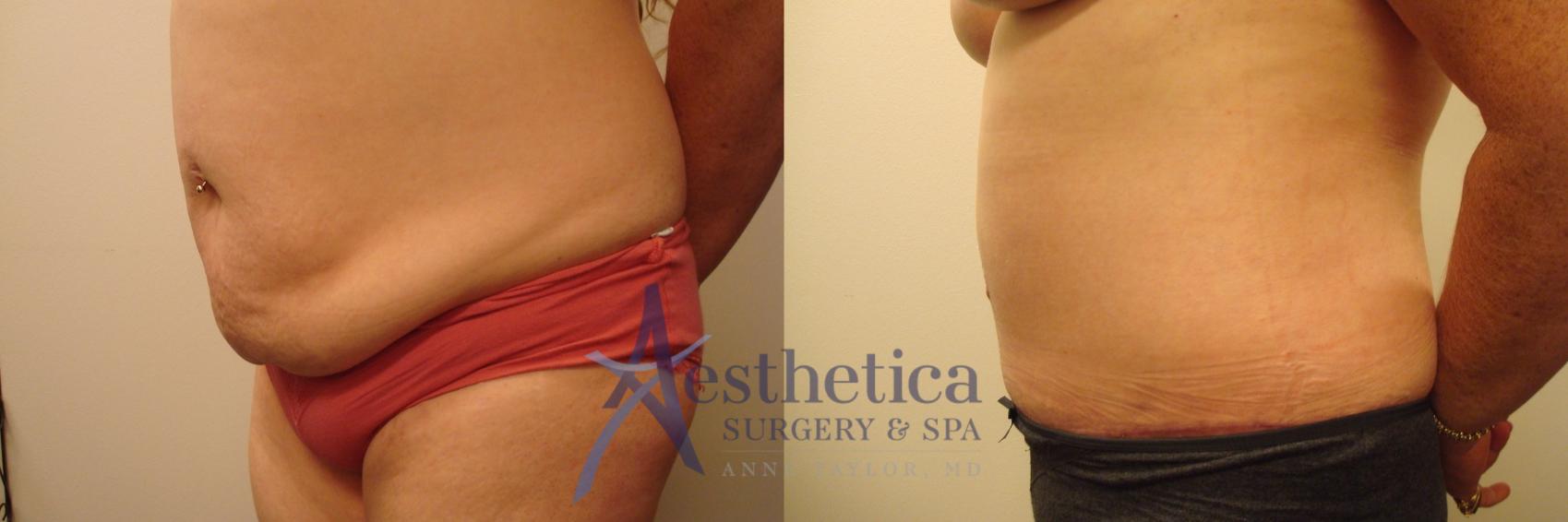 Tummy Tuck Case 452 Before & After Front | Columbus, OH | Aesthetica Surgery & Spa
