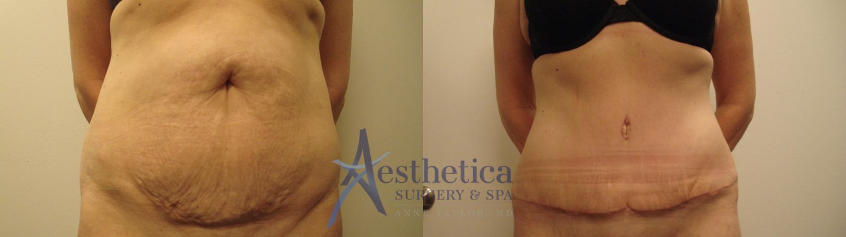 Tummy Tuck Case 490 Before & After Front | Columbus, OH | Aesthetica Surgery & Spa