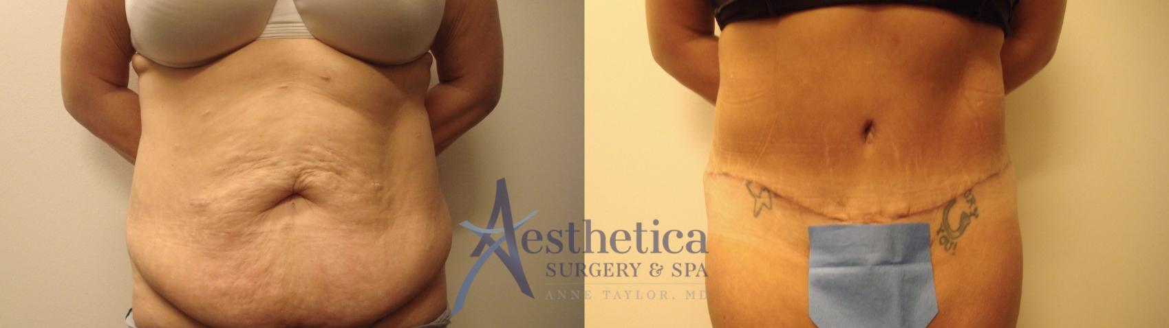 Tummy Tuck Case 493 Before & After Front | Worthington, OH | Aesthetica Surgery & Spa