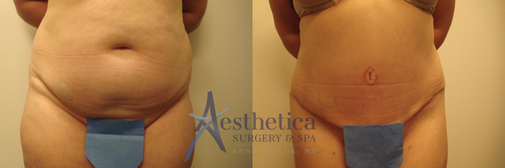 Tummy Tuck Case 499 Before & After Front | Worthington, OH | Aesthetica Surgery & Spa