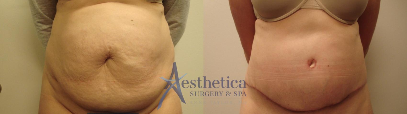 Tummy Tuck Case 504 Before & After Front | Columbus, OH | Aesthetica Surgery & Spa