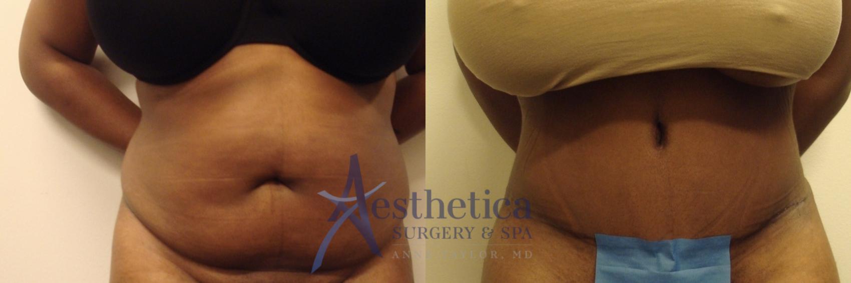 Tummy Tuck Case 507 Before & After Front | Columbus, OH | Aesthetica Surgery & Spa