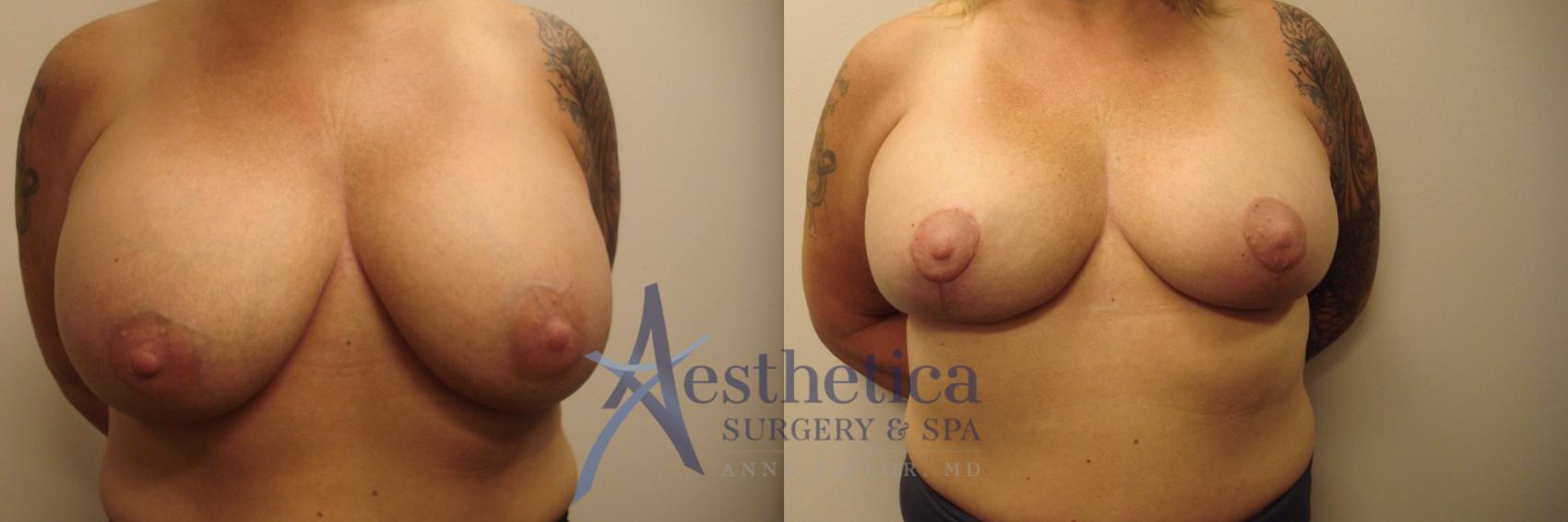 Breast Augmentation Revision Case 531 Before & After Front | Worthington, OH | Aesthetica Surgery & Spa