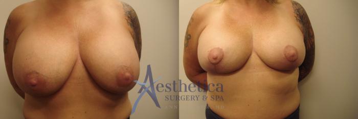 Breast Augmentation Revision Case 531 Before & After Front | Columbus, OH | Aesthetica Surgery & Spa