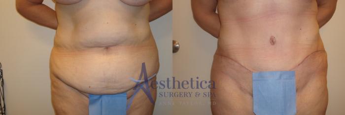 Tummy Tuck Case 535 Before & After Front | Columbus, OH | Aesthetica Surgery & Spa