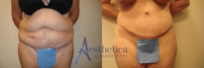 Tummy Tuck Case 543 Before & After Front | Columbus, OH | Aesthetica Surgery & Spa