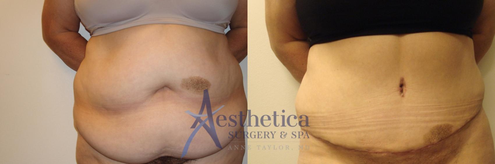 Tummy Tuck Case 544 Before & After Front | Columbus, OH | Aesthetica Surgery & Spa
