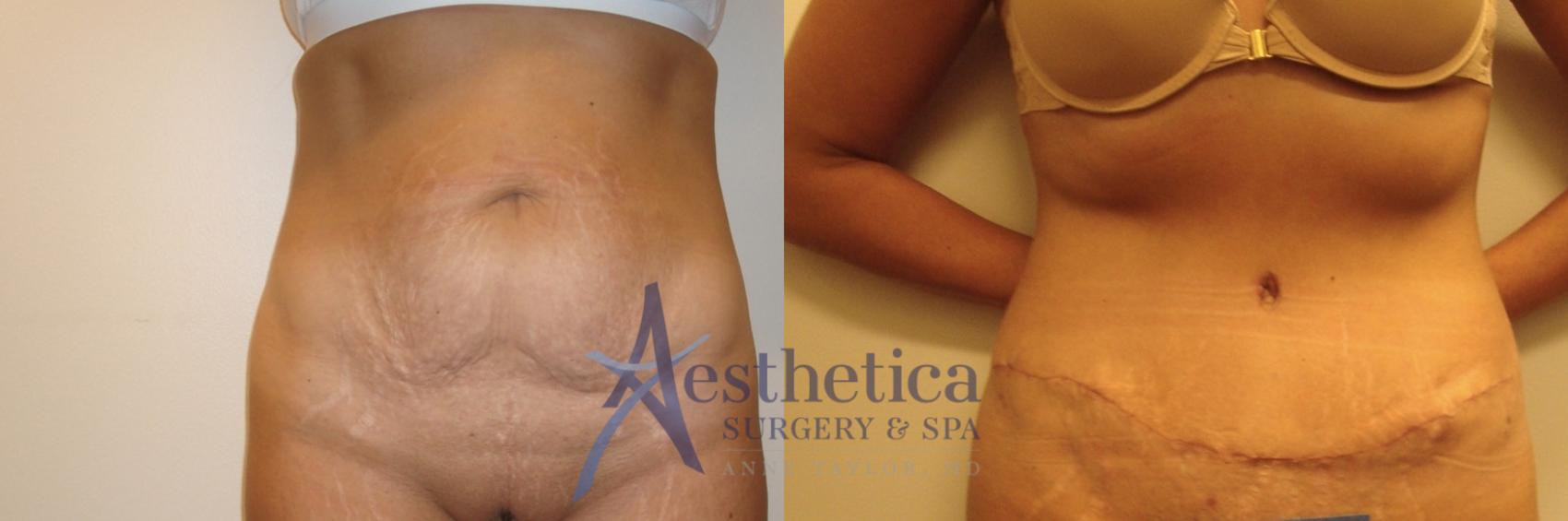 Tummy Tuck Case 546 Before & After Front | Columbus, OH | Aesthetica Surgery & Spa