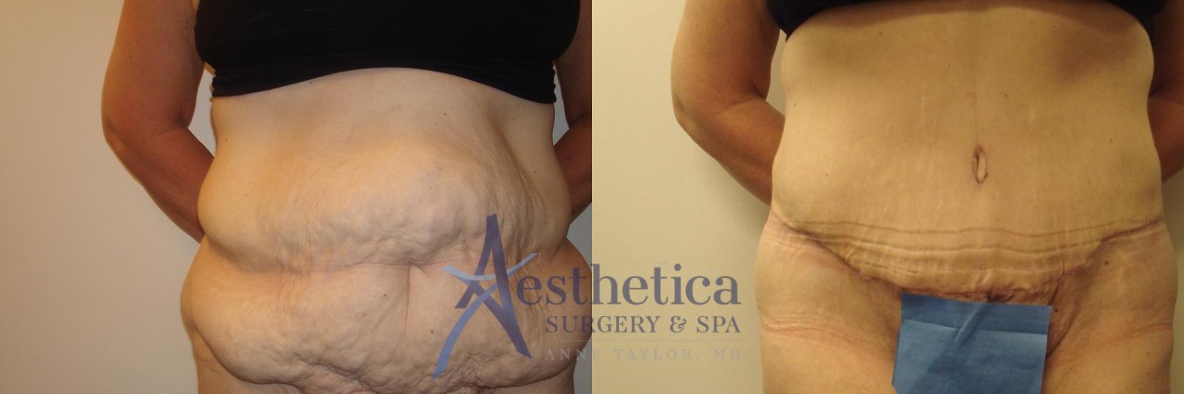 Tummy Tuck Case 556 Before & After Front | Columbus, OH | Aesthetica Surgery & Spa