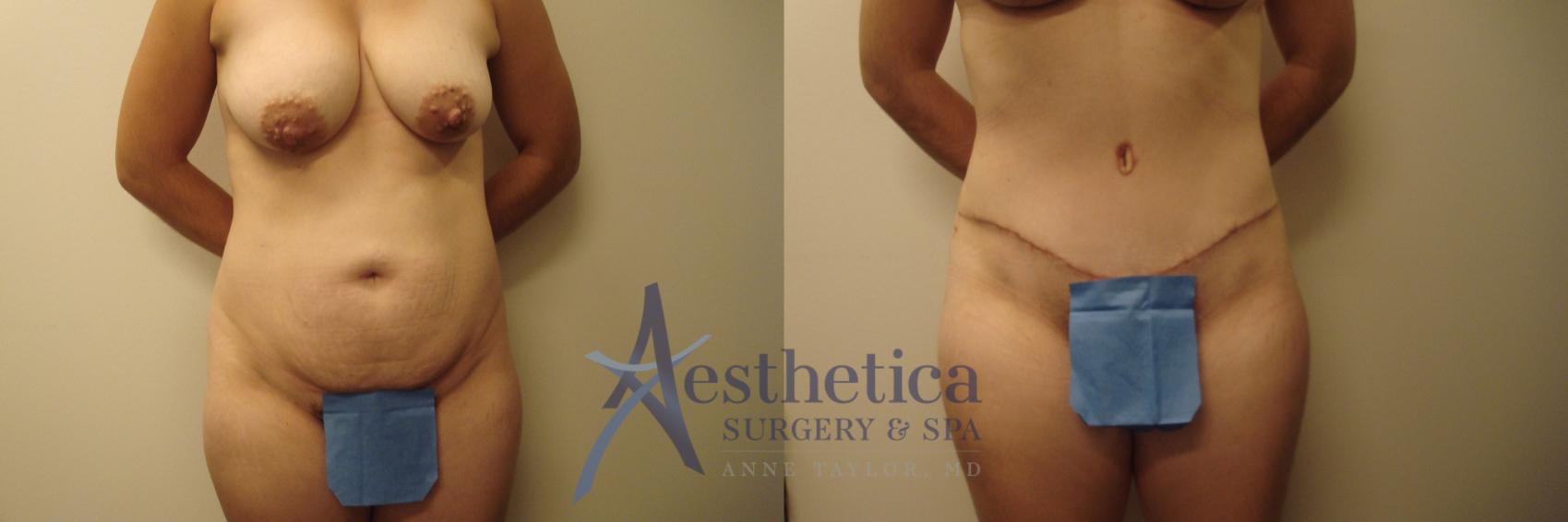 Tummy Tuck Case 561 Before & After Front | Columbus, OH | Aesthetica Surgery & Spa