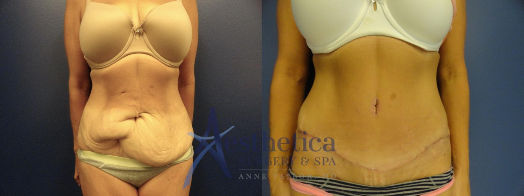 Tummy Tuck Case 57 Before & After View #1 | Columbus, OH | Aesthetica Surgery & Spa