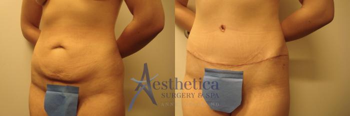 Tummy Tuck Case 582 Before & After Front | Columbus, OH | Aesthetica Surgery & Spa