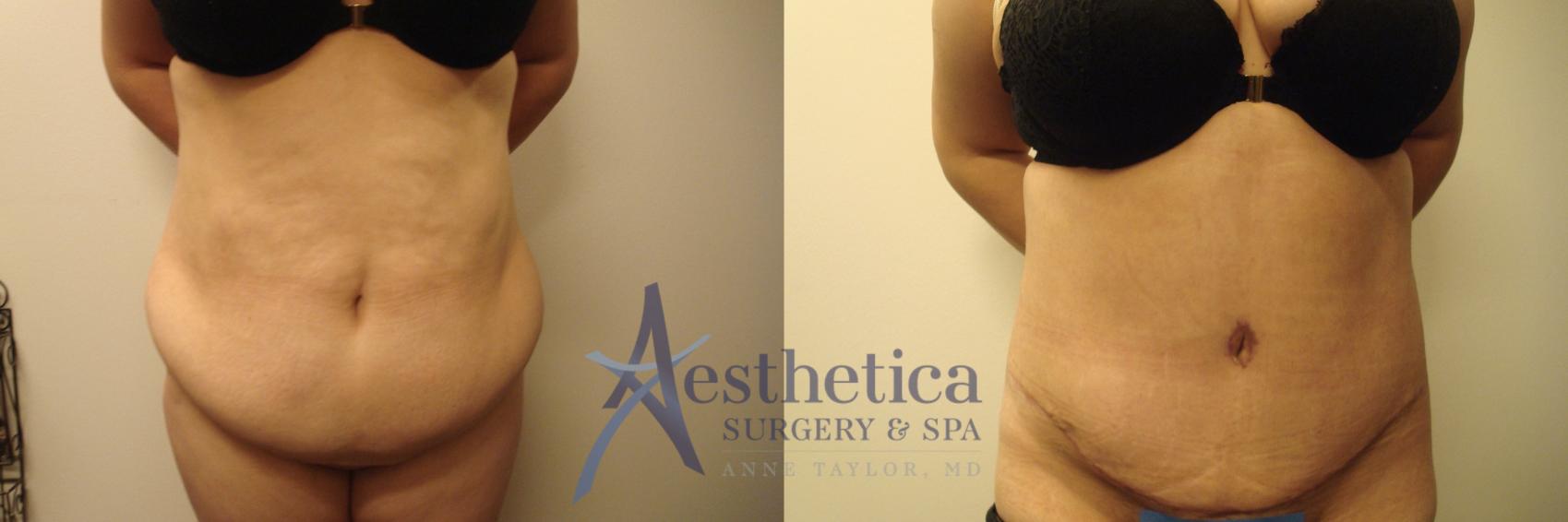 Tummy Tuck Case 585 Before & After Front | Columbus, OH | Aesthetica Surgery & Spa