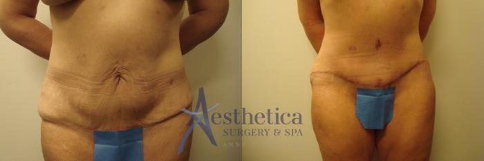 Tummy Tuck Case 588 Before & After Front | Columbus, OH | Aesthetica Surgery & Spa