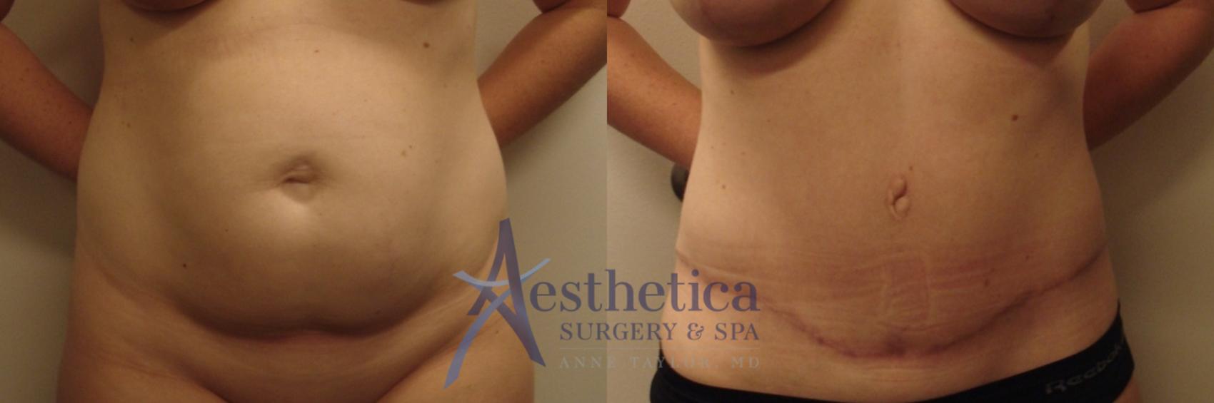 Tummy Tuck Case 592 Before & After Front | Columbus, OH | Aesthetica Surgery & Spa
