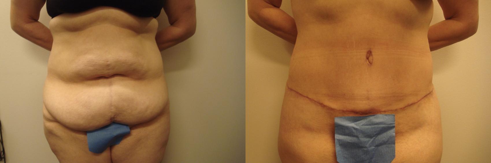 Tummy Tuck Case 596 Before & After Front | Columbus, OH | Aesthetica Surgery & Spa