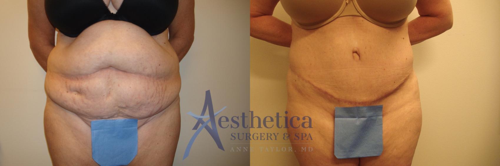 Tummy Tuck Case 598 Before & After Front | Worthington, OH | Aesthetica Surgery & Spa