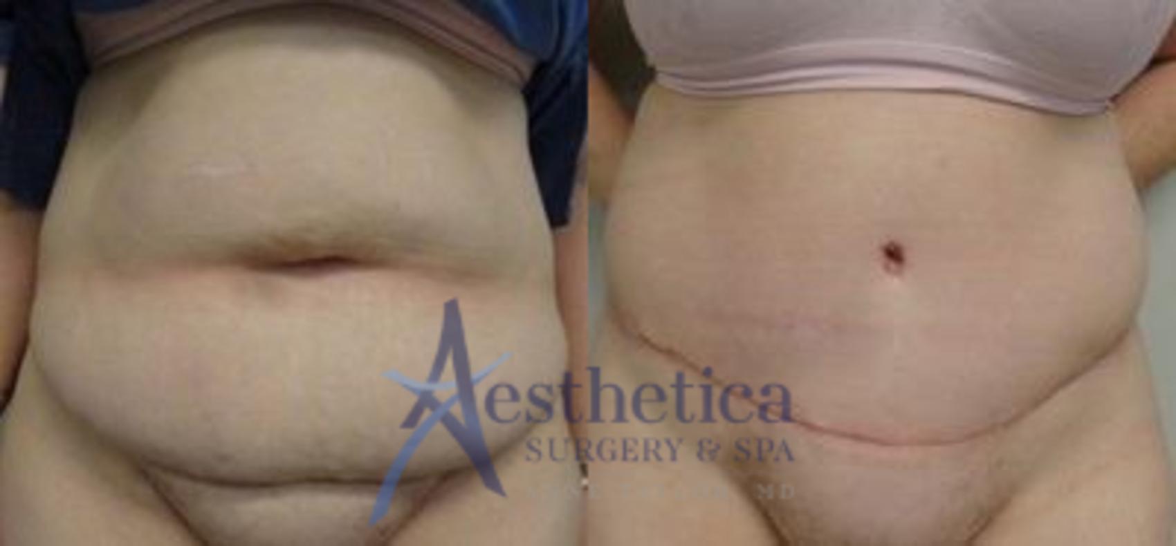 Tummy Tuck Case 6 Before & After View #1 | Columbus, OH | Aesthetica Surgery & Spa