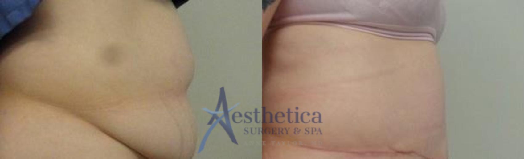 Tummy Tuck Case 6 Before & After View #2 | Worthington, OH | Aesthetica Surgery & Spa