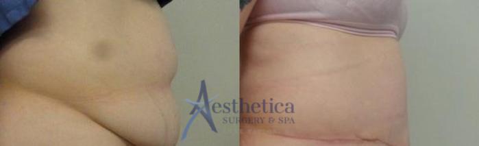 Tummy Tuck Case 6 Before & After View #2 | Columbus, OH | Aesthetica Surgery & Spa
