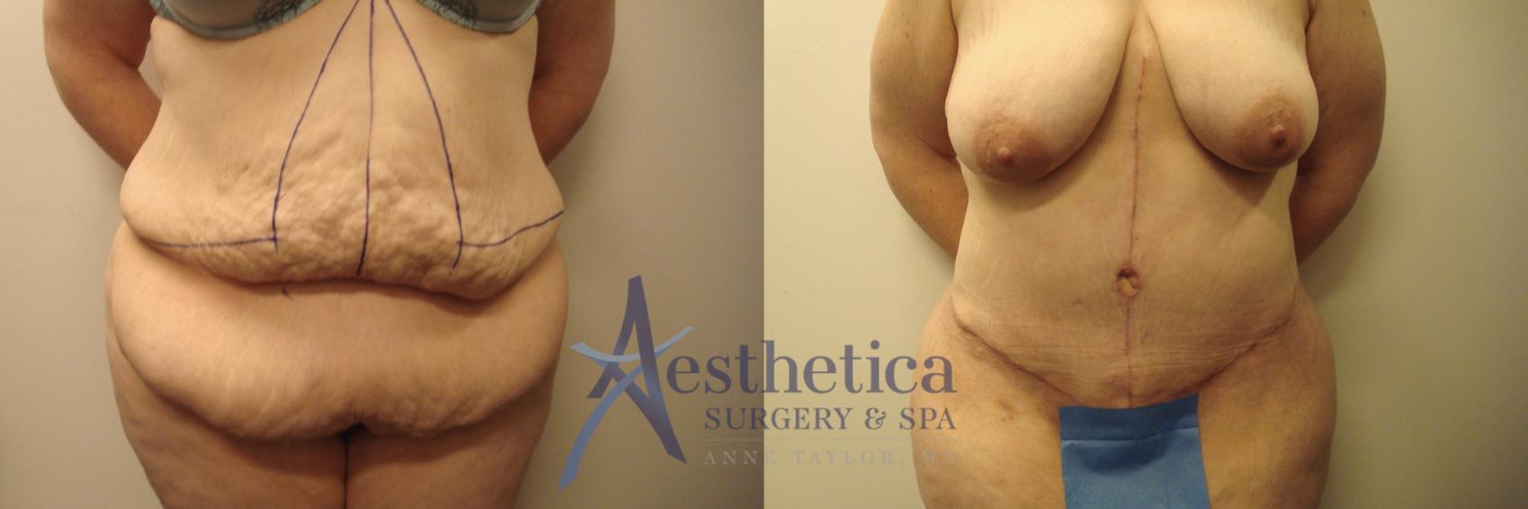 Tummy Tuck Case 600 Before & After Front | Columbus, OH | Aesthetica Surgery & Spa
