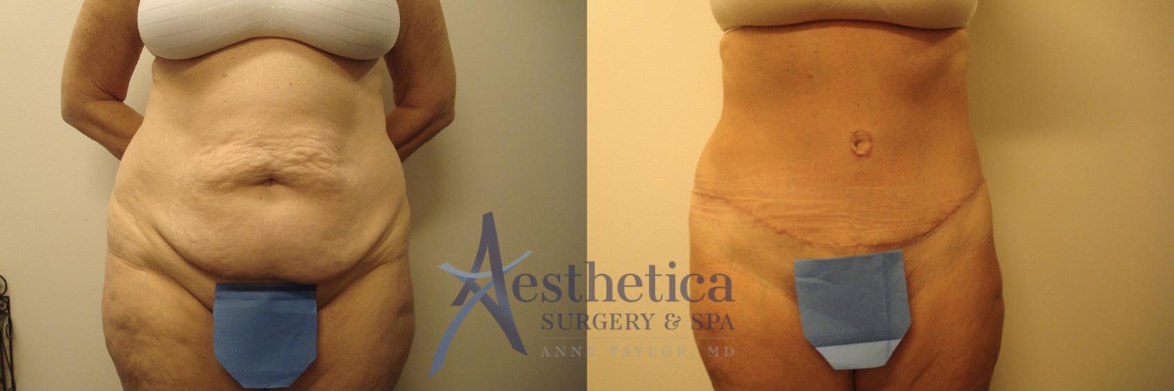 Tummy Tuck Case 601 Before & After Front | Columbus, OH | Aesthetica Surgery & Spa