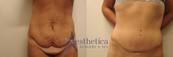 Tummy Tuck Case 610 Before & After Front | Columbus, OH | Aesthetica Surgery & Spa