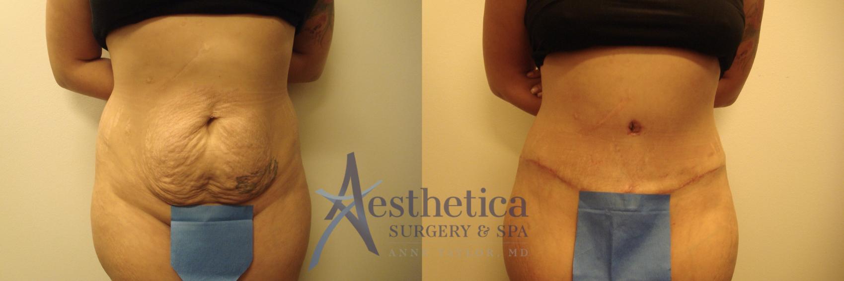 Tummy Tuck Case 611 Before & After Front | Columbus, OH | Aesthetica Surgery & Spa