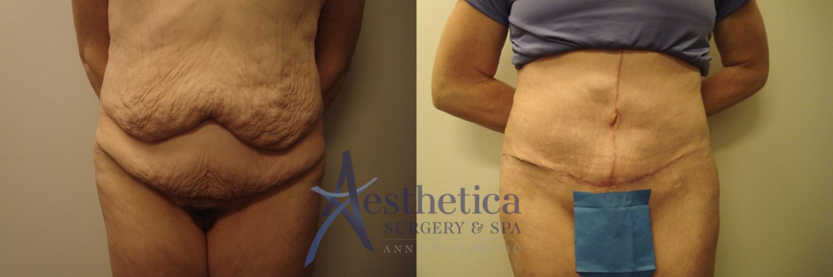 Tummy Tuck Case 612 Before & After Front | Columbus, OH | Aesthetica Surgery & Spa
