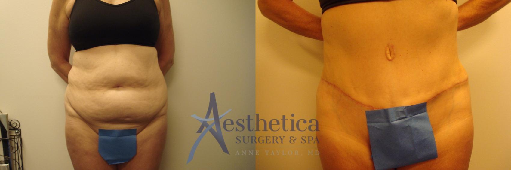 Tummy Tuck Case 613 Before & After Front | Worthington, OH | Aesthetica Surgery & Spa
