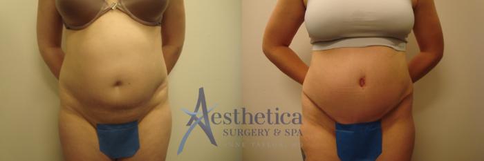 Tummy Tuck Case 614 Before & After Front | Columbus, OH | Aesthetica Surgery & Spa