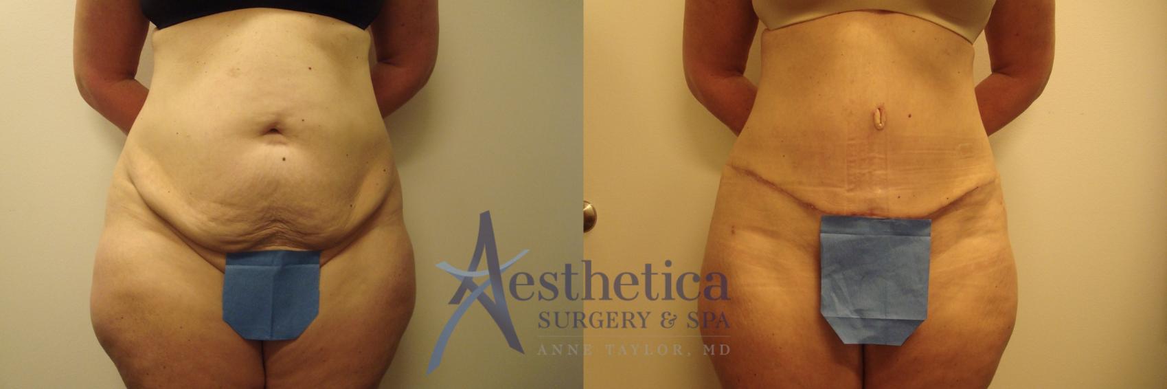 Tummy Tuck Case 625 Before & After Front | Columbus, OH | Aesthetica Surgery & Spa