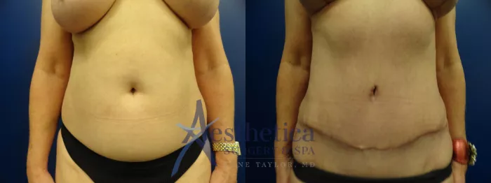 Tummy Tuck Before & After Photos Patient 63, Columbus, OH