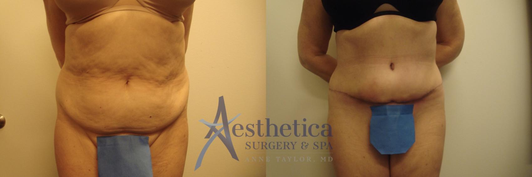 Tummy Tuck Case 635 Before & After Front | Columbus, OH | Aesthetica Surgery & Spa