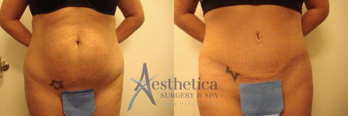 Tummy Tuck Case 641 Before & After Front | Columbus, OH | Aesthetica Surgery & Spa