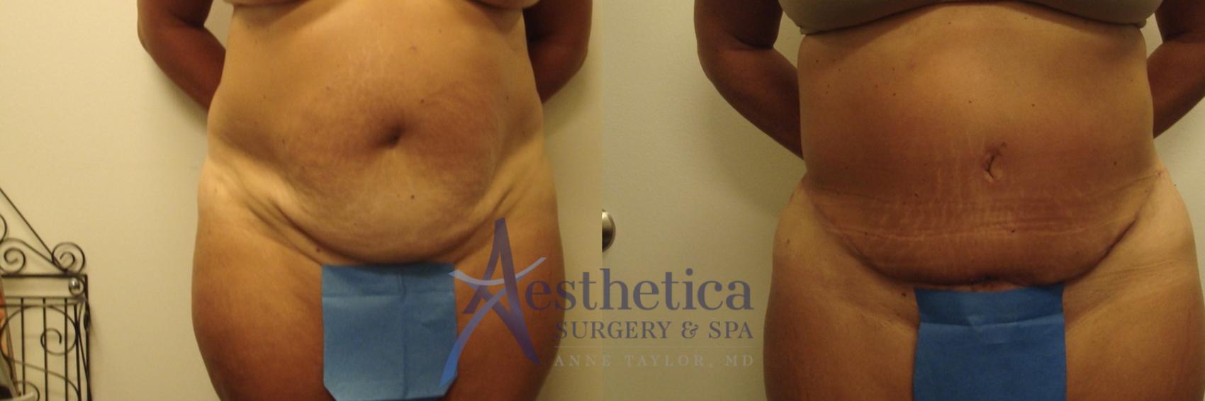 Tummy Tuck Case 643 Before & After Front | Columbus, OH | Aesthetica Surgery & Spa