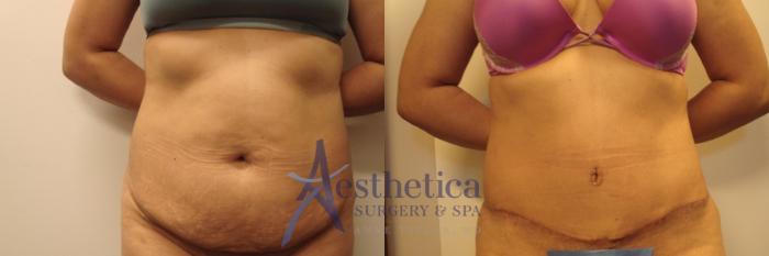 Tummy Tuck Case 648 Before & After Front | Columbus, OH | Aesthetica Surgery & Spa