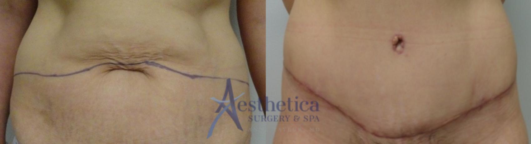 Tummy Tuck Case 65 Before & After View #1 | Worthington, OH | Aesthetica Surgery & Spa