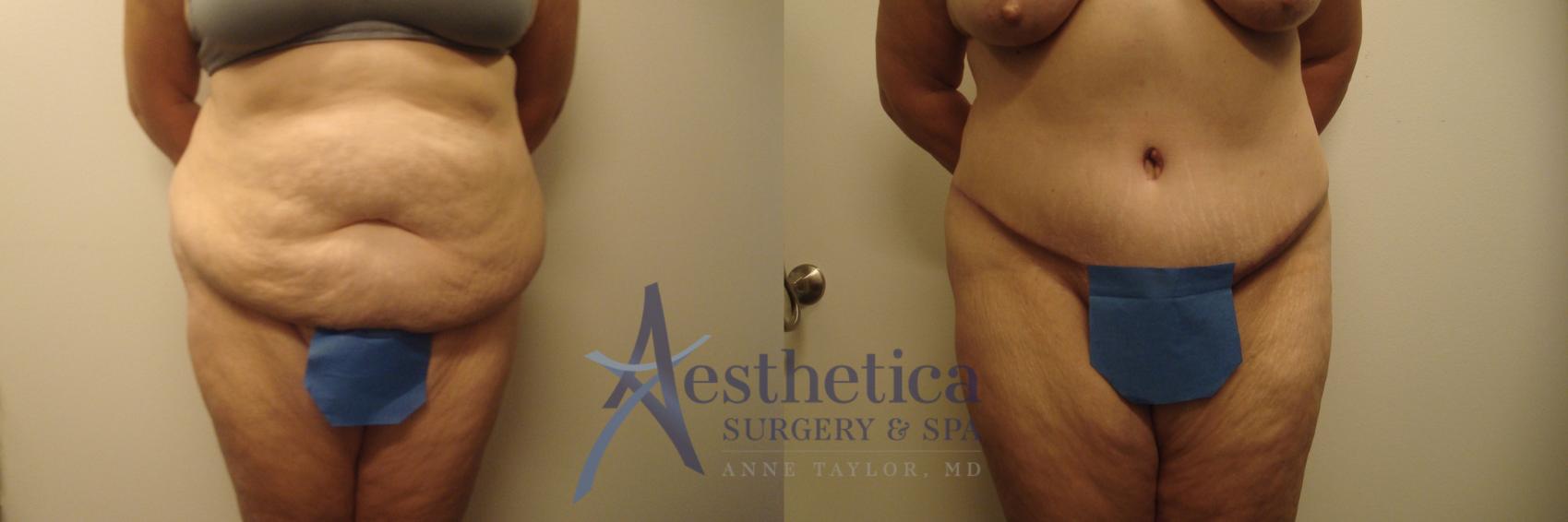 Tummy Tuck Case 651 Before & After Front | Worthington, OH | Aesthetica Surgery & Spa