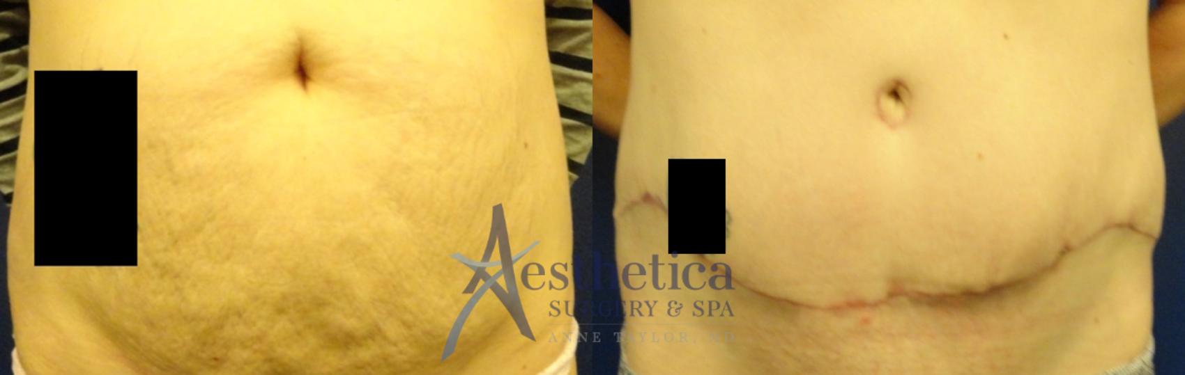 Tummy Tuck Case 66 Before & After View #1 | Columbus, OH | Aesthetica Surgery & Spa