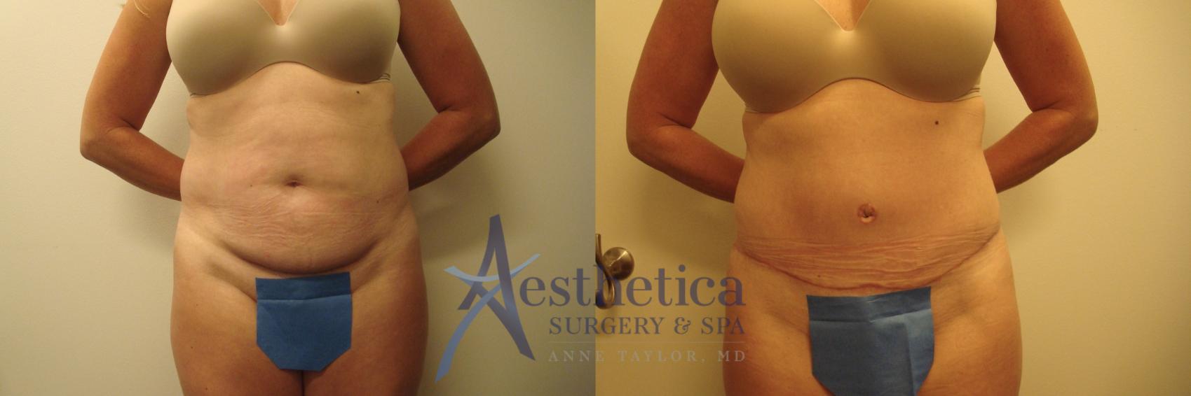 Tummy Tuck Case 662 Before & After Front | Columbus, OH | Aesthetica Surgery & Spa