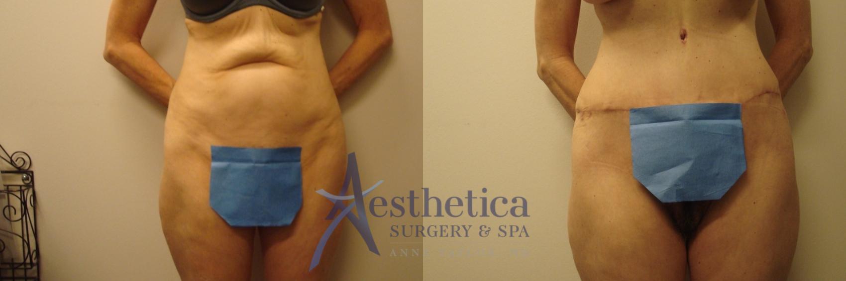 Tummy Tuck Case 689 Before & After Front | Columbus, OH | Aesthetica Surgery & Spa
