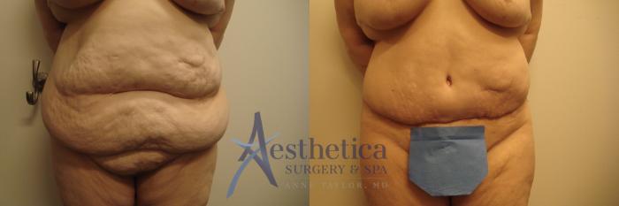 Tummy Tuck Case 693 Before & After Front | Columbus, OH | Aesthetica Surgery & Spa