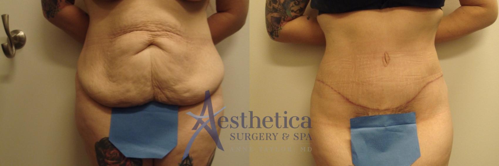 Tummy Tuck Case 694 Before & After Front | Columbus, OH | Aesthetica Surgery & Spa
