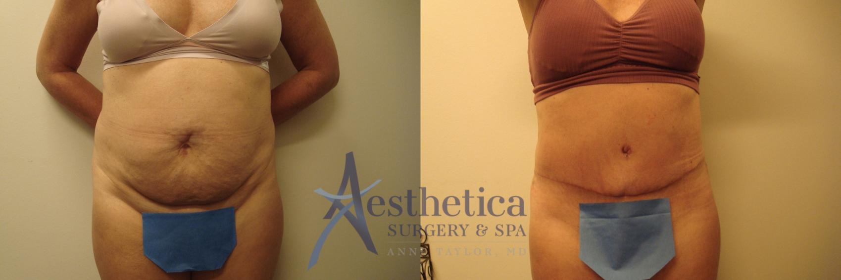 Tummy Tuck Case 699 Before & After Front | Columbus, OH | Aesthetica Surgery & Spa