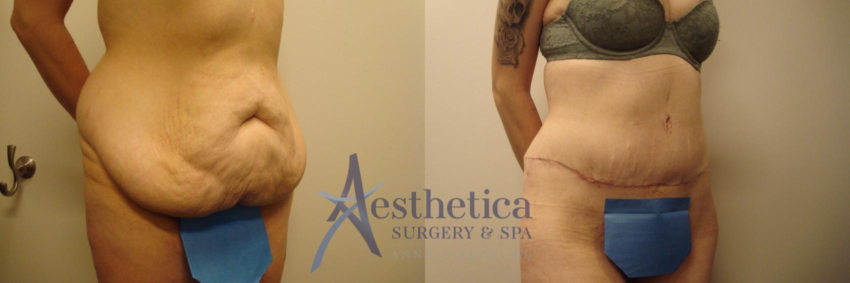 Tummy Tuck Case 700 Before & After Front | Columbus, OH | Aesthetica Surgery & Spa