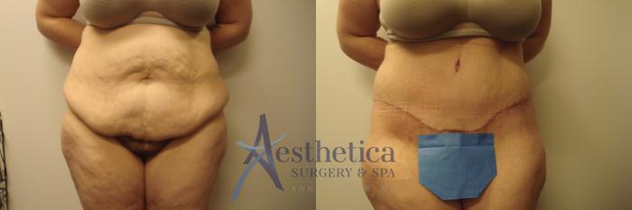 Tummy Tuck Case 702 Before & After Front | Columbus, OH | Aesthetica Surgery & Spa