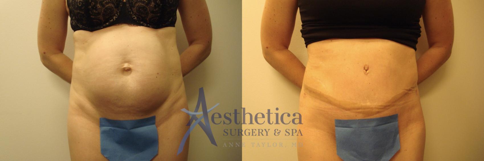 Tummy Tuck Case 707 Before & After Front | Columbus, OH | Aesthetica Surgery & Spa