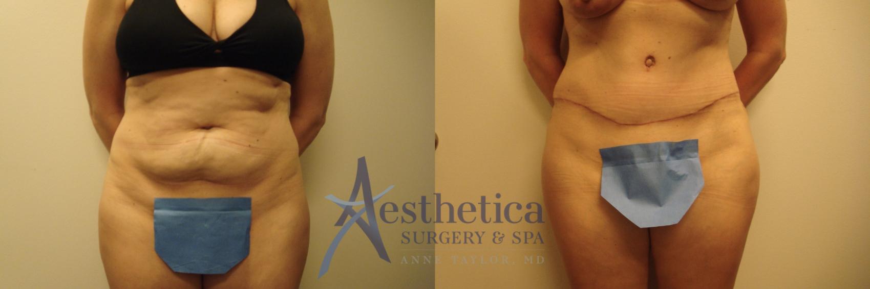 Tummy Tuck Case 716 Before & After Front | Columbus, OH | Aesthetica Surgery & Spa